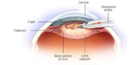 cataract surgery huddersfield|Mr. Z. Estephan consultant cataract surgeon and retina specialist.
